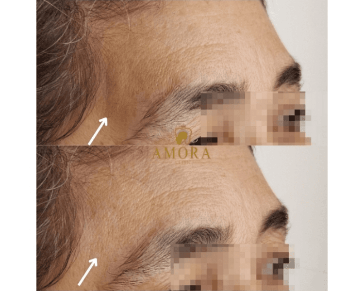 Relleno de zona temporal– $200.000 (M. Hyafilia) /$280.000 (M.Juvederm)