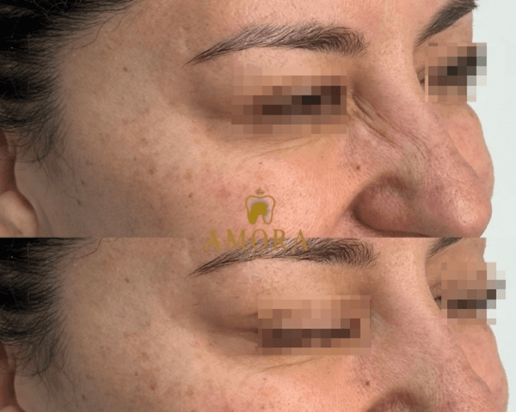 Arrugas nasales o Bunny lines