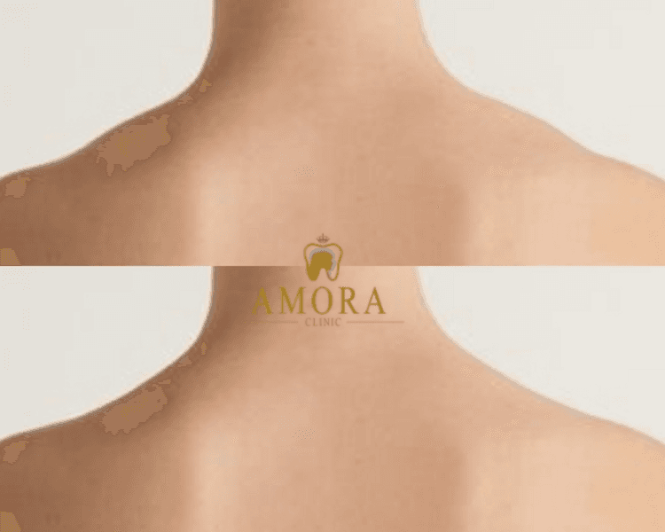 Trap box- Cuello de barbie