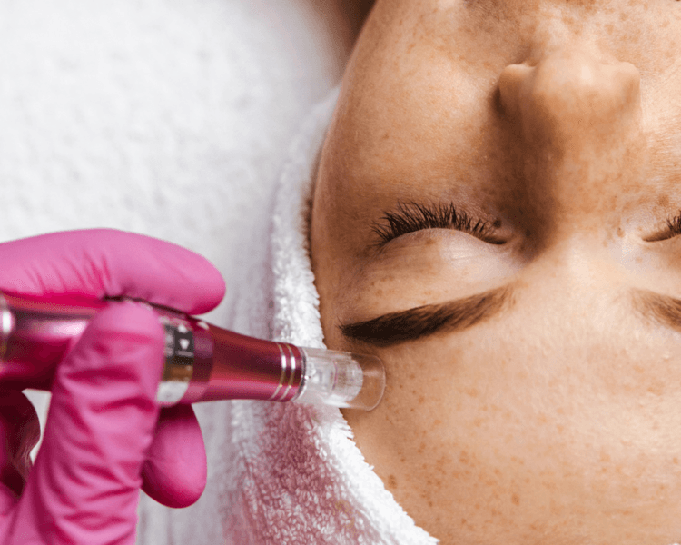 Exosomas -Microneedling (Pack 3 sesiones)