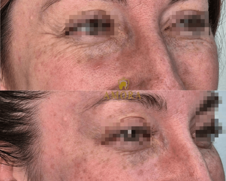 Bótox Tercio superior(Entrecejo, frente, P.gallo): 1 zona :$95.000/ 2 zonas:$150.000/ 3 zonas:$180.000