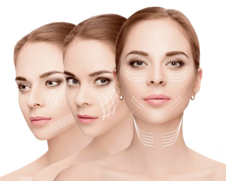 Lifting full face con Ácido hialurónico (Tercio medio/inferior)