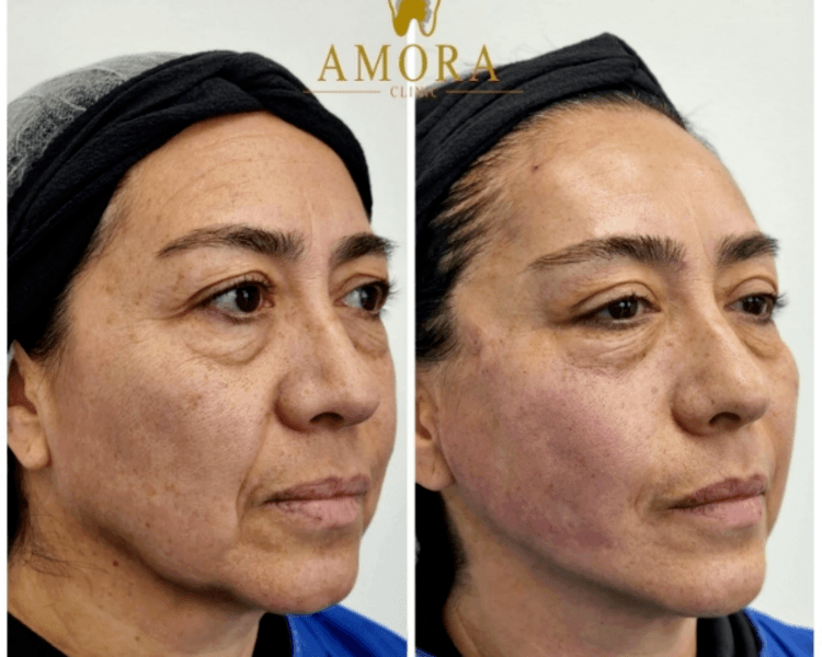 Lifting full face con Hilos de tracción (Tercio medio/inferior)