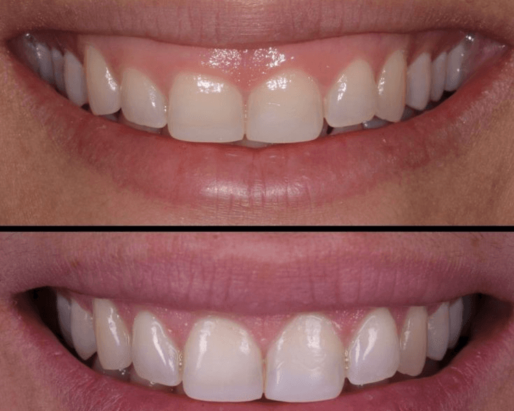 Gingivectomia quirúrgica