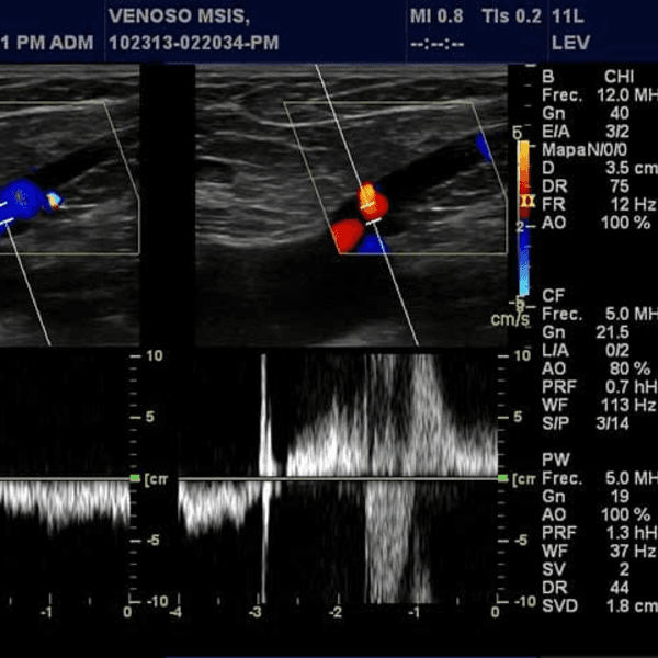 Eco doppler venoso extremidades