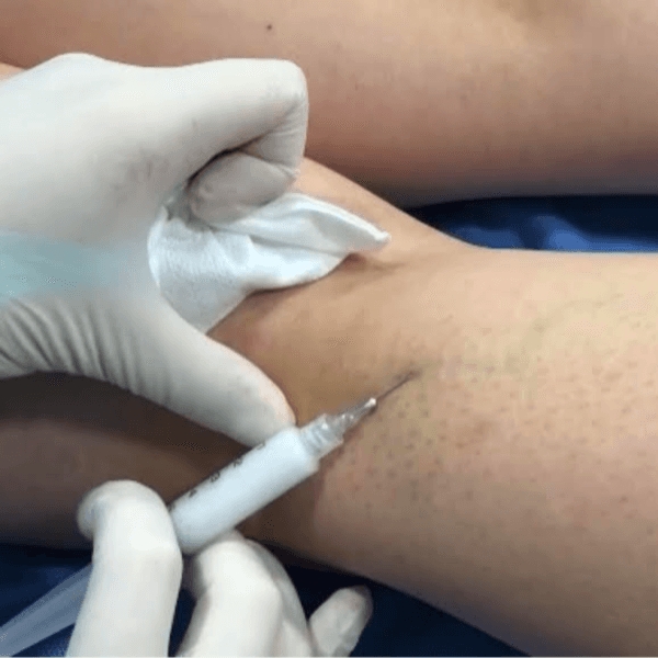 Escleroterapia (1 sesión)