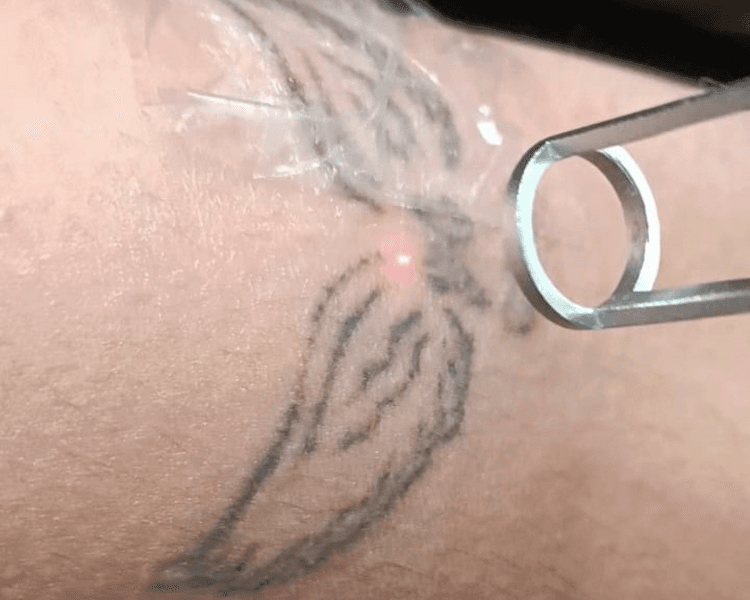 Valoración - Remoción de Tatuajes corporales