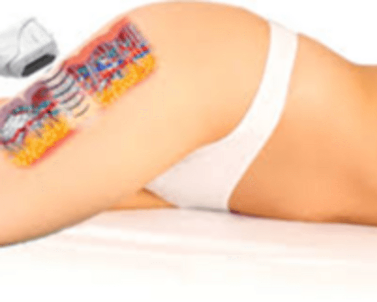 HIFU 14D PRO MAX CON LIPOSONIC : 2 ZONAS