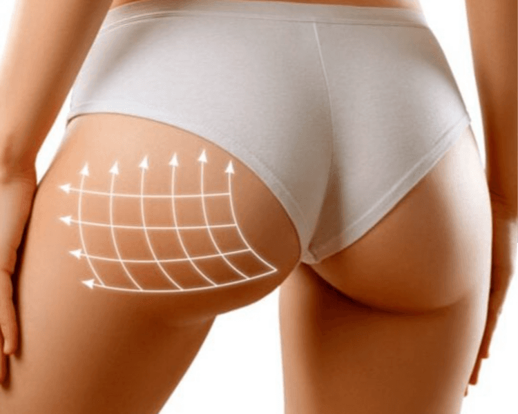 🔥 HIFU Corporal: Esculpí tu cuerpo sin cirugía 🔥 Alta intensidad, resultados visibles: Glúteos