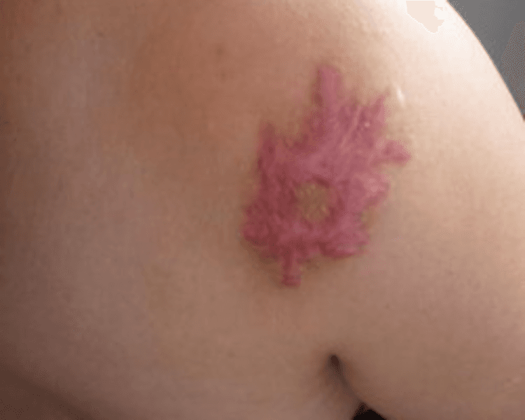 Infiltraciones Perilesionales OZONO ( 10 sesiones)