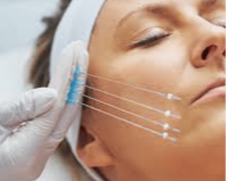 🧵✨ Hilos Tensores de Colágeno Lifting sin cirugía, colágeno en acción 💫