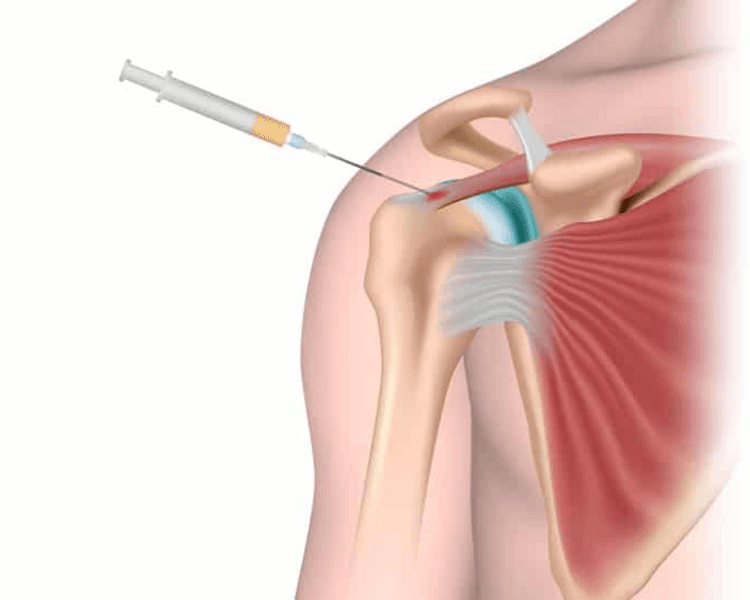 Infiltraciones de Triamcinolona en Ambas Articulaciones