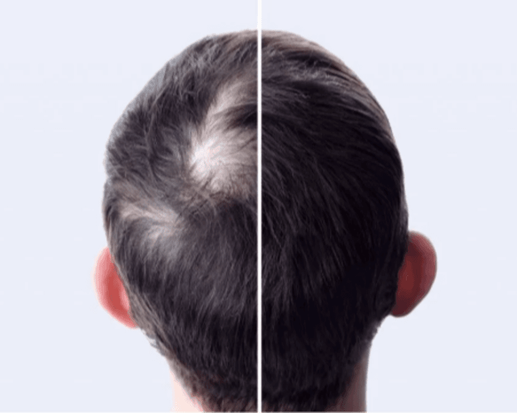 Embolado Capilar 5 Sesiones