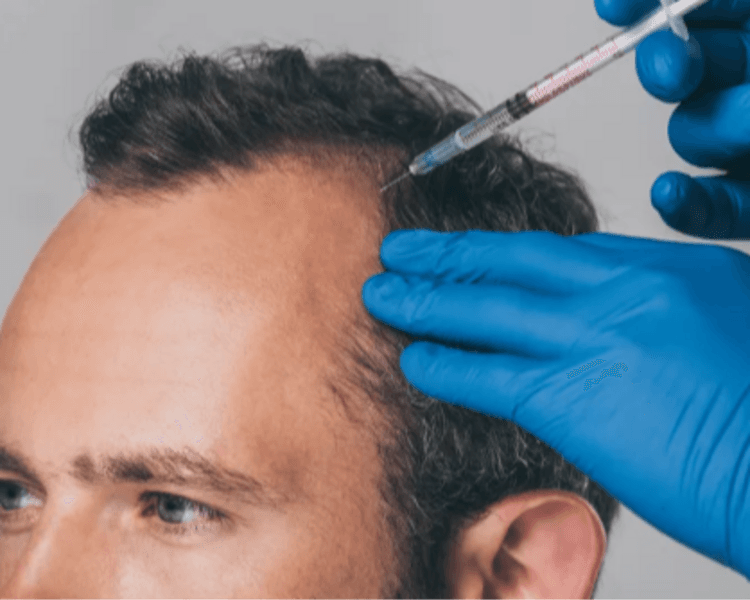 Tratamiento Capilar con Ozono (Infiltraciones + Embolsado) 8 Sesiones