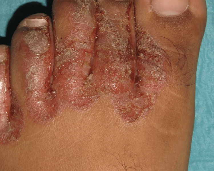 Aplicacion Podologica de Ozono/Ozone Podiatry Application