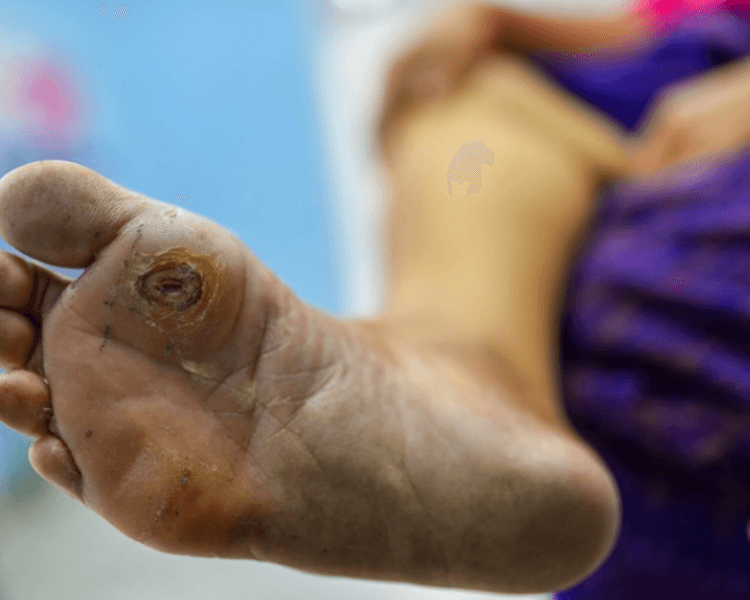 Aplicacion Podologica de Ozono/Ozone Podiatry Application ( 2 sesiones)