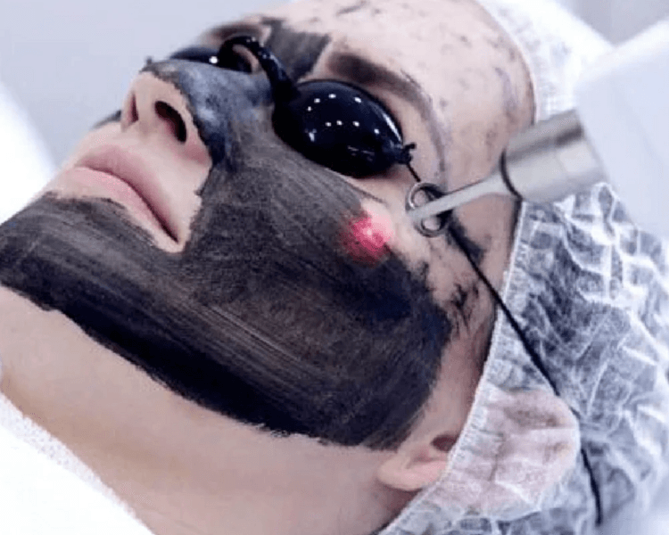 ✨ ND:YAG Picosecond Hollywood Peel