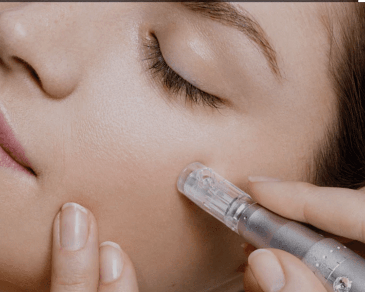 Tratamiento Microneedling
