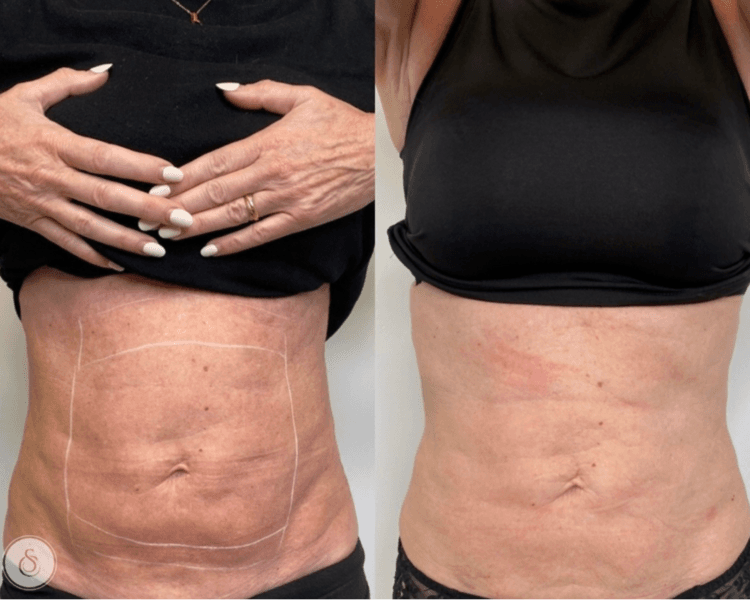 Reafirmante abdomen y cintura con HIFU 12D