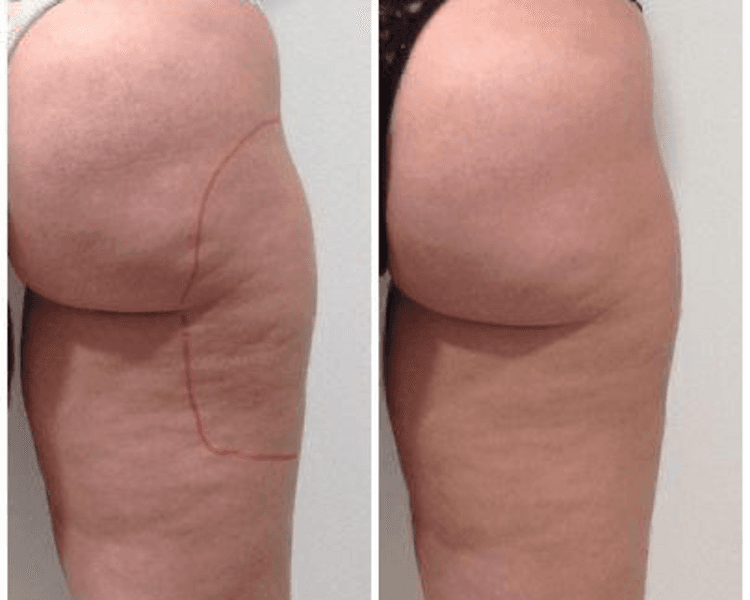 Reafirmante zona baja del glúteo con HIFU 12D (y para celulitis)