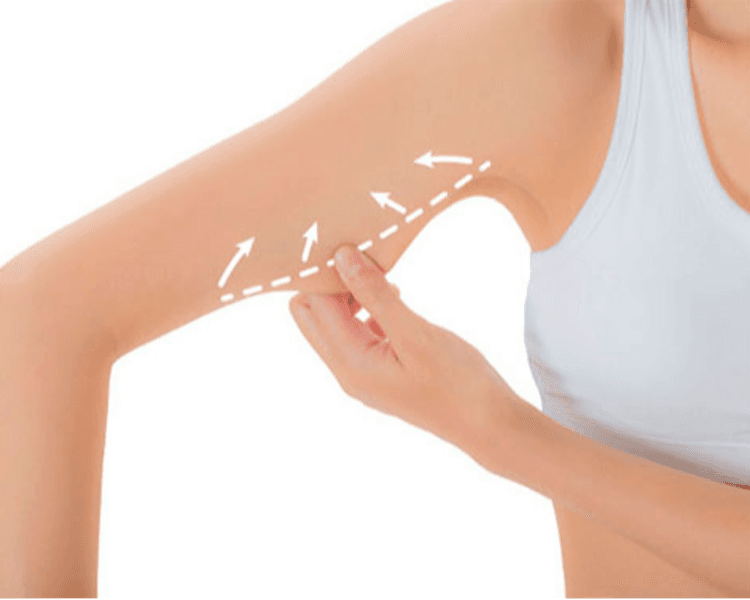 Reafirmante brazo superior con HIFU 12D