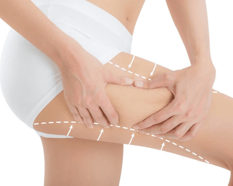 Reafirmante muslo interno y externo con HIFU 12D