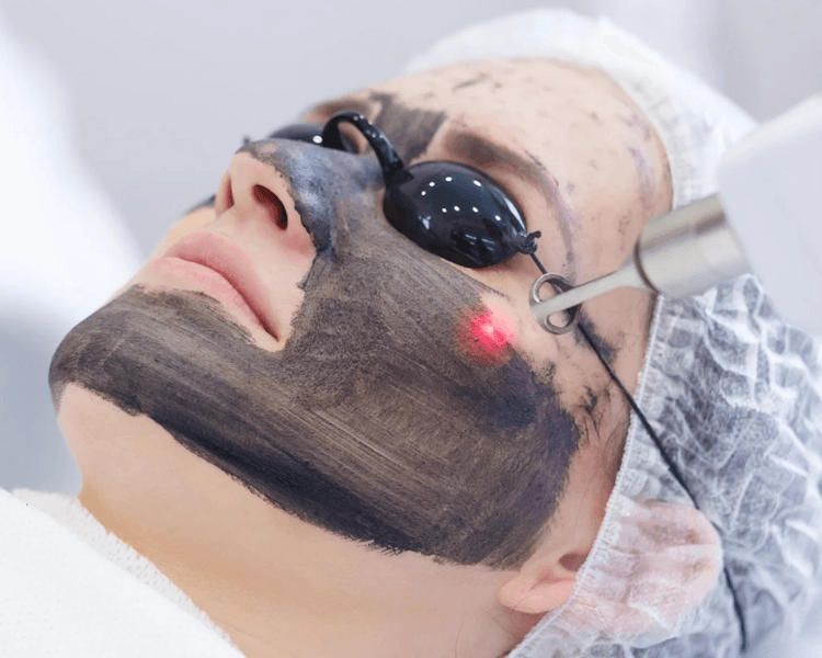 Hollywood Peel (láser Q-switch)