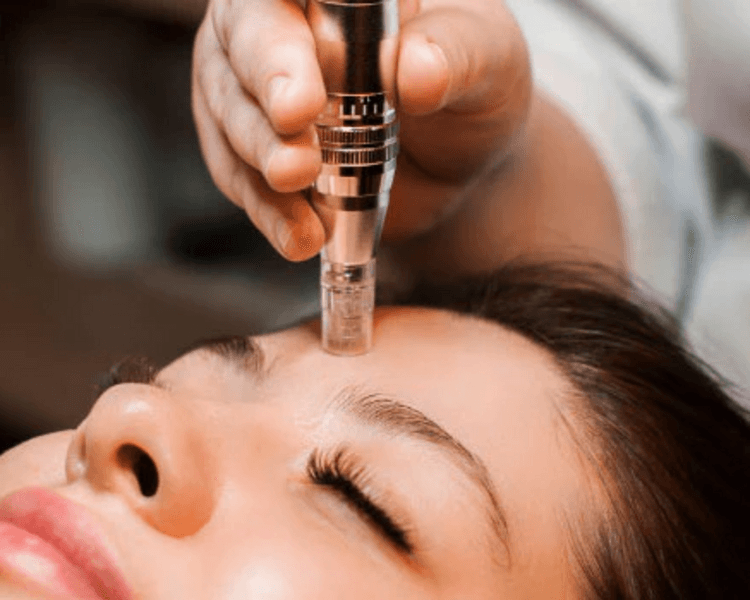 Terapia con micropunción