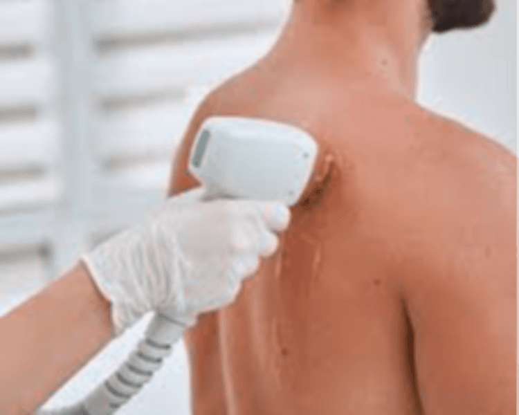 Depilación - Espalda completa