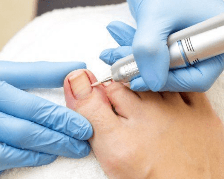 Onicocriptosis (uña encarnada) 1 borde