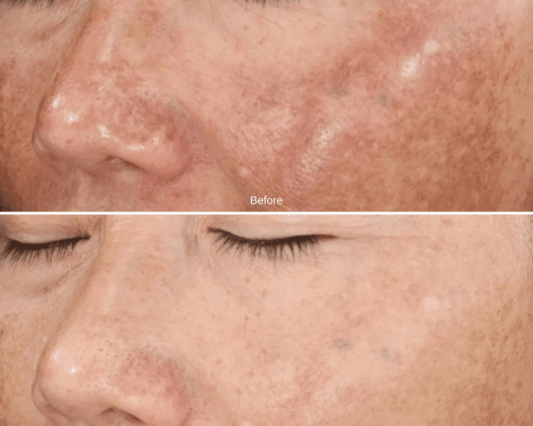 🧬 Tratamiento Despigmentante MELINE 1 sesion Peeling