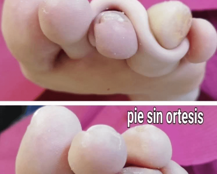 Ortesis silicona 1 unidad (desde )