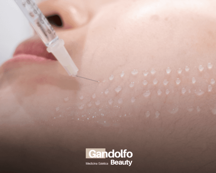 Mesoterapia importada