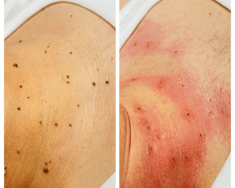 Remoción de Verrugas