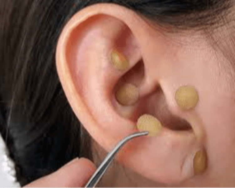 Auriculoterapia Recambio