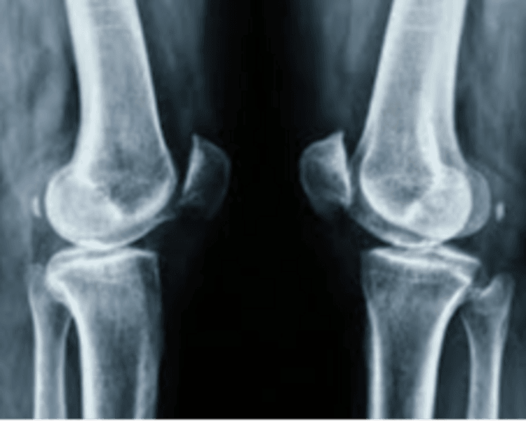 RADIOGRAFIAS DE RODILLA AP Y LATERAL