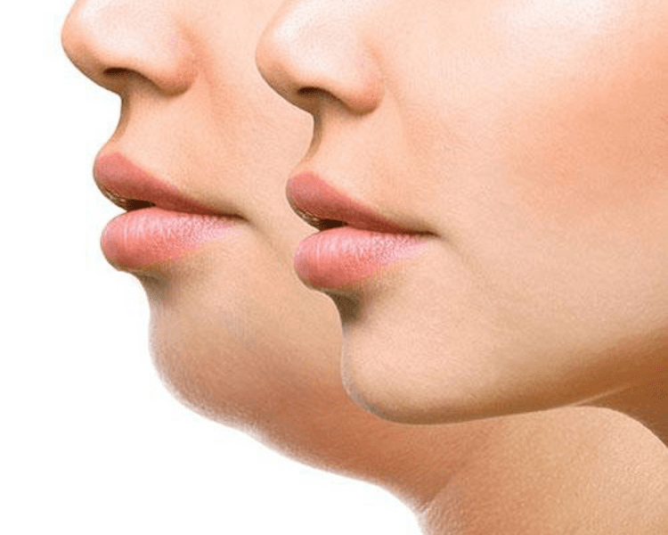 BICHECTOMIA ENZIMATICA