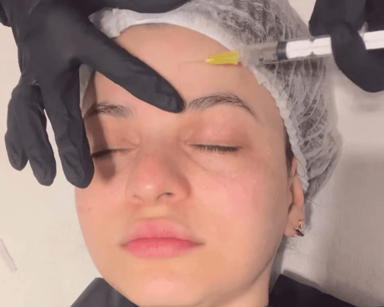 Mesoterapia Facial