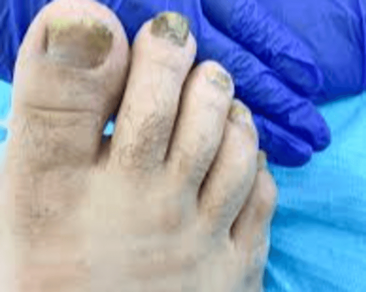 🔬 Fresado profundo de uñas micóticas