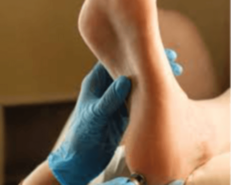 ⚠️ Onicofosis y helomas interdigitales