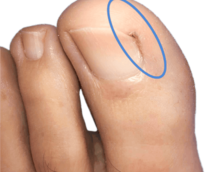 🦷 Uña encarnada unilateral con granuloma