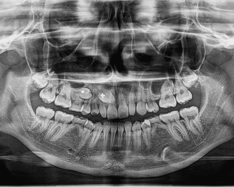 RX 1 ORTOPANTOMOGRAFIA (PANORAMICA)