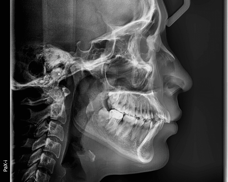 RX 2 RADIOGRAFIA LATERAL DE CRANEO (CEFALOMETRICA)