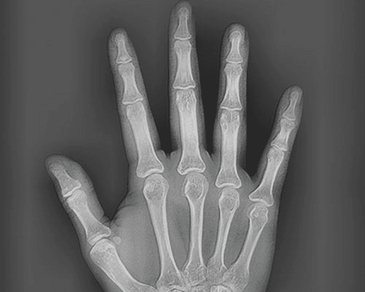RX 5 RADIOGRAFIA CARPAL (MANO)
