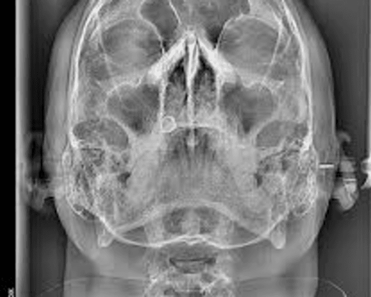 RX 7 RADIOGRAFIA WATERS