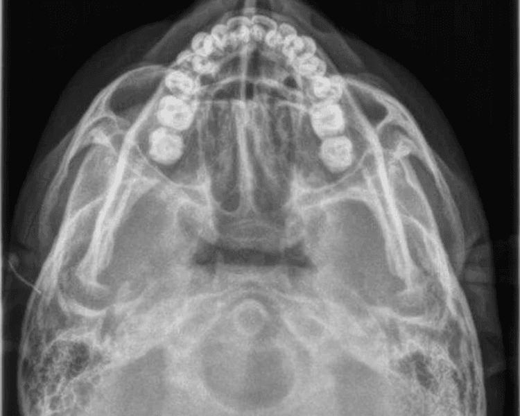 RX 9.1 RADIOGRAFIA SMV SUBMENTOVERTICAL