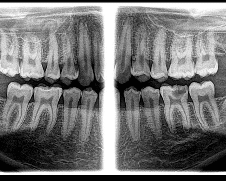 RX 9.3 RADIOGRAFIA INCISIVOS MOLARES
