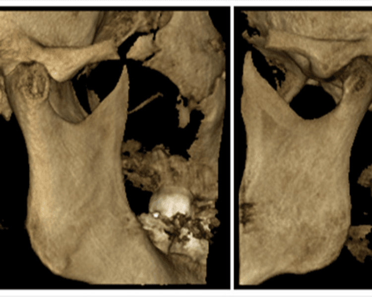 TOMOGRAFIA DIENTES IMPACTADOS