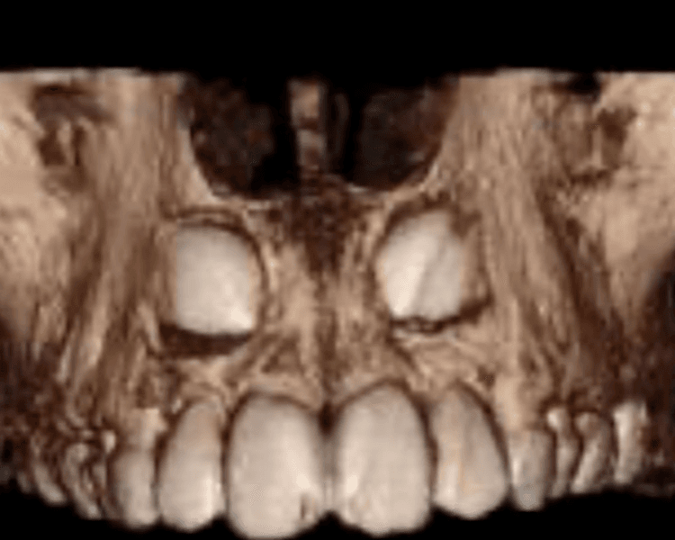 TOMOGRAFIA MAXILAR SUPERIOR ( FOV 8X5, 8X9, )