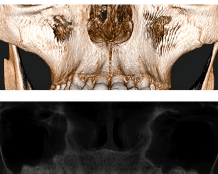TOMOGRAFIA VIAS AREAS